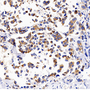 Immunohistochemistry analysis of paraffin-embedded human lung cancer using BSG Polyclonal Antibody at dilution of 1:200.