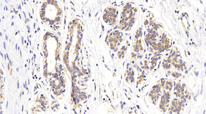 Immunohistochemistry analysis of paraffin-embedded human breast cancer using ATG7 Polyclonal Antibody at dilution of 1:400.