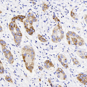 Immunohistochemistry analysis of paraffin-embedded human liver cancer using ATG5 Polyclonal Antibody at dilution of 1:400.