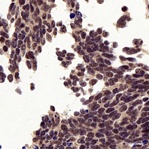 Immunohistochemistry analysis of paraffin-embedded Human lung cancer using P38 Polyclonal Antibody at dilution of 1:500.