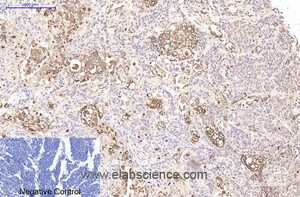 Immunohistochemistry of paraffin-embedded Human lung cancer tissue using CD15 Monoclonal Antibody at dilution of 1:200.