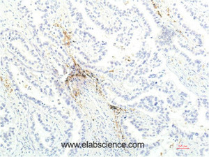 Immunohistochemistry of paraffin-embedded Human lung carcinoma tissue using JAK1 Monoclonal Antibody at dilution of 1:200.