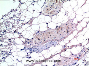 Immunohistochemistry of paraffin-embedded Human liver carcinoma tissue using Smad3 Monoclonal Antibody at dilution of 1:200.