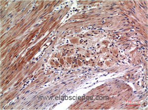 Immunohistochemistry of paraffin-embedded Human colon carcinoma tissue with Phospho-ERK 1/2 (Tyr222/205) Monoclonal Antibody at dilution of 1:200