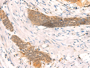 Immunohistochemistry of paraffin-embedded Human esophagus cancer tissue using SETD1A Polyclonal Antibody at dilution of 1:40 (×200)