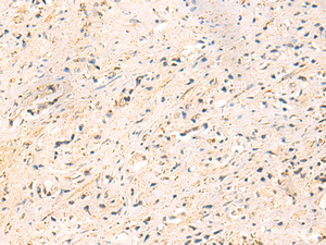 Immunohistochemistry of paraffin-embedded Human prost at e cancer tissue using IP6K3 Polyclonal Antibody at dilution of 1:50 (×200)