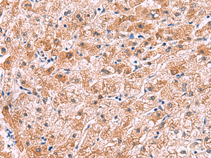 Immunohistochemistry of paraffin-embedded Human liver cancer tissue using IL4R Polyclonal Antibody at dilution of 1:45 (×200)