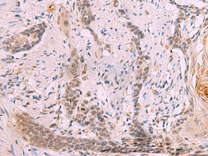 Immunohistochemistry of paraffin-embedded Human esophagus cancer tissue using INO80 Polyclonal Antibody at dilution of 1:70 (×200)