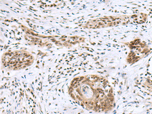 Immunohistochemistry of paraffin-embedded Human esophagus cancer tissue using INSM1 Polyclonal Antibody at dilution of 1:50 (×200)