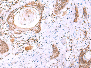 Immunohistochemistry of paraffin-embedded Human esophagus cancer tissue using ITPKC Polyclonal Antibody at dilution of 1:30 (×200)