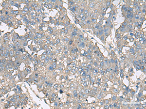 Immunohistochemistry of paraffin-embedded Human liver cancer tissue using TNF Polyclonal Antibody at dilution of 1:40 (×200)