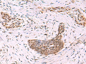 Immunohistochemistry of paraffin-embedded Human esophagus cancer tissue using CREBBP Polyclonal Antibody at dilution of 1:35 (×200)