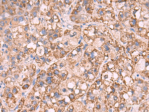 Immunohistochemistry of paraffin-embedded Human liver cancer tissue using KCNN1 Polyclonal Antibody at dilution of 1:55 (×200)