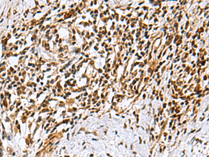 Immunohistochemistry of paraffin-embedded Human esophagus cancer tissue using KDM2B Polyclonal Antibody at dilution of 1:40 (×200)