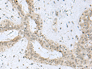 Immunohistochemistry of paraffin-embedded Human breast cancer tissue using KDM3B Polyclonal Antibody at dilution of 1:40 (×200)