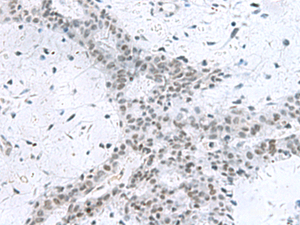 Immunohistochemistry of paraffin-embedded Human breast cancer tissue using PCLAF Polyclonal Antibody at dilution of 1:80 (×200)