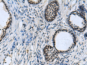 Immunohistochemistry of paraffin-embedded Human prost at e cancer tissue using CCAR2 Polyclonal Antibody at dilution of 1:40 (×200)