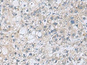 Immunohistochemistry of paraffin-embedded Human liver cancer tissue using KCNJ2 Polyclonal Antibody at dilution of 1:35 (×200)