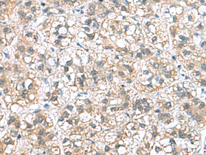 Immunohistochemistry of paraffin-embedded Human liver cancer tissue using NFKB1 Polyclonal Antibody at dilution of 1:50 (×200)