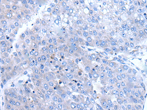 Immunohistochemistry of paraffin-embedded Human liver cancer tissue using BTG4 Polyclonal Antibody at dilution of 1:65 (×200)