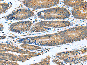 Immunohistochemistry of paraffin-embedded Human colorectal cancer tissue using CLEC1B Polyclonal Antibody at dilution of 1:55 (×200)