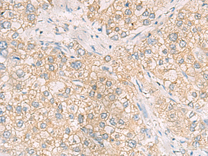 Immunohistochemistry of paraffin-embedded Human liver cancer tissue using MAPK14 Polyclonal Antibody at dilution of 1:70 (×200)