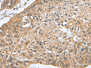 Immunohistochemistry of paraffin-embedded Human esophagus cancer tissue using PDCD5 Polyclonal Antibody at dilution of 1:105 (×200)