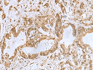Immunohistochemistry of paraffin-embedded Human gastric cancer tissue using PHF6 Polyclonal Antibody at dilution of 1:85 (×200)