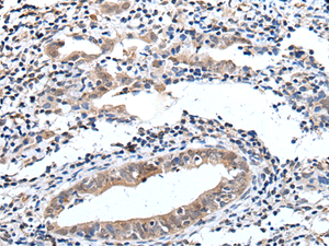 Immunohistochemistry of paraffin-embedded Human cervical cancer tissue using ELMO1 Polyclonal Antibody at dilution of 1:40 (×200)