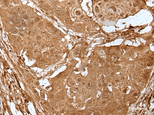 Immunohistochemistry of paraffin-embedded Human esophagus cancer tissue using LIPG Polyclonal Antibody at dilution of 1:50 (×200)