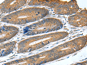 Immunohistochemistry of paraffin-embedded Human colorectal cancer tissue using HSD11B1 Polyclonal Antibody at dilution of 1:70 (×200)