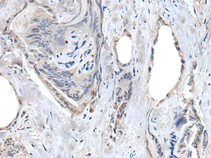 Immunohistochemistry of paraffin-embedded Human thyroid cancer tissue using RASSF8 Polyclonal Antibody at dilution of 1:55 (×200)