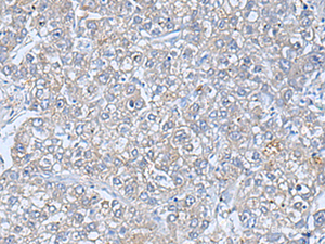 Immunohistochemistry of paraffin-embedded Human liver cancer tissue using TREM1 Polyclonal Antibody at dilution of 1:50 (×200)