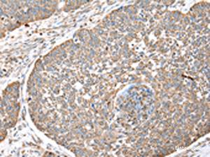 Immunohistochemistry of paraffin-embedded Human lung cancer tissue using DPH7 Polyclonal Antibody at dilution of 1:40 (×200)