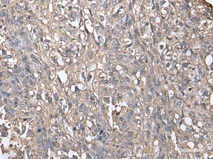 Immunohistochemistry of paraffin-embedded Human lung cancer tissue using NDUFB5 Polyclonal Antibody at dilution of 1:45 (×200)