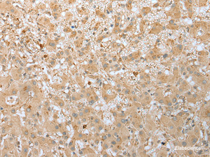 Immunohistochemistry of paraffin-embedded Human liver cancer tissue using FNDC3B Polyclonal Antibody at dilution of 1:45 (×200)