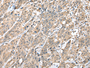 Immunohistochemistry of paraffin-embedded Human colorectal cancer tissue using HIF1A Polyclonal Antibody at dilution of 1:45 (×200)