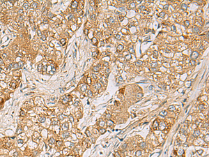 Immunohistochemistry of paraffin-embedded Human liver cancer tissue using LRRC28 Polyclonal Antibody at dilution of 1:80 (×200)