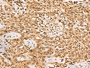 Immunohistochemistry of paraffin-embedded Human ovarian cancer tissue using LRRC2 Polyclonal Antibody at dilution of 1:70 (×200)