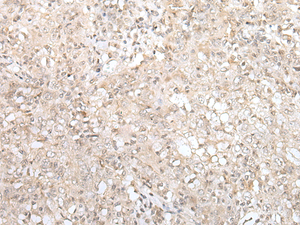 Immunohistochemistry of paraffin-embedded Human esophagus cancer tissue using ZNF263 Polyclonal Antibody at dilution of 1:40 (×200)