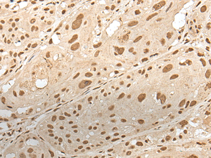 Immunohistochemistry of paraffin-embedded Human esophagus cancer tissue using ZNF274 Polyclonal Antibody at dilution of 1:35 (×200)