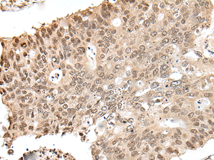 Immunohistochemistry of paraffin-embedded Human colorectal cancer tissue using ZNF410 Polyclonal Antibody at dilution of 1:40 (×200)