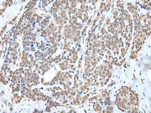 Immunohistochemistry of paraffin-embedded Human thyroid cancer tissue using WTAP Polyclonal Antibody at dilution of 1:35 (×200)