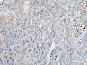 Immunohistochemistry of paraffin-embedded Human lung cancer tissue using VWA2 Polyclonal Antibody at dilution of 1:45 (×200)