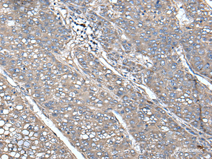 Immunohistochemistry of paraffin-embedded Human liver cancer tissue using UNC13B Polyclonal Antibody at dilution of 1:85 (×200)