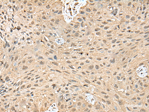 Immunohistochemistry of paraffin-embedded Human lung cancer tissue using ATXN3 Polyclonal Antibody at dilution of 1:50 (×200)