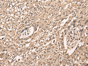 Immunohistochemistry of paraffin-embedded Human lung cancer tissue using ATF7 Polyclonal Antibody at dilution of 1:40 (×200)