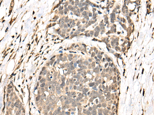 Immunohistochemistry of paraffin-embedded Human thyroid cancer tissue using BATF Polyclonal Antibody at dilution of 1:40 (×200)