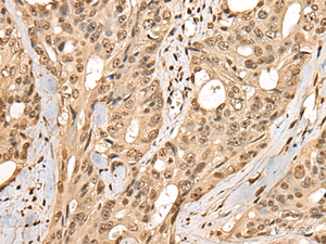 Immunohistochemistry of paraffin-embedded Human colorectal cancer tissue using PHF21A Polyclonal Antibody at dilution of 1:50 (×200)