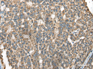 Immunohistochemistry of paraffin-embedded Human liver cancer tissue using BLNK Polyclonal Antibody at dilution of 1:65 (×200)